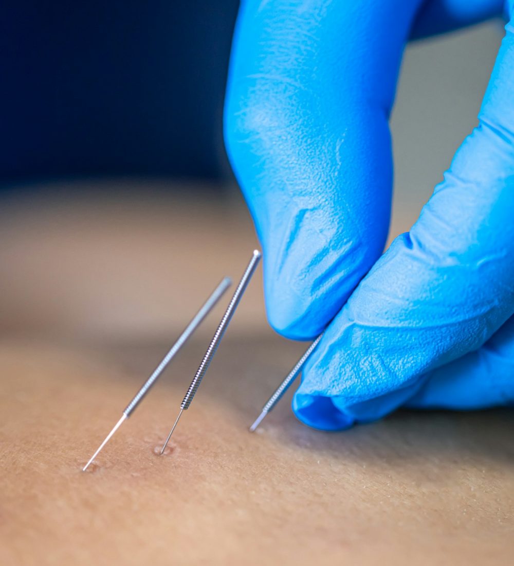 Close up of a needle and hands of physiotherapist doing a dry needling.
